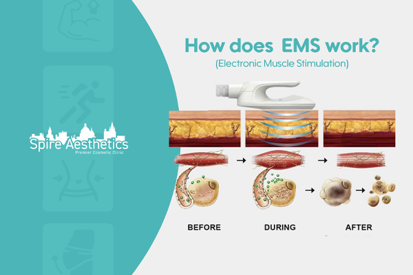 EMS treatment for post pregnancy weight loss treatment Thrapston