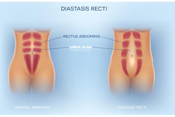 What Non-Surgical Options Are Available for Diastasis Recti Thrapston?