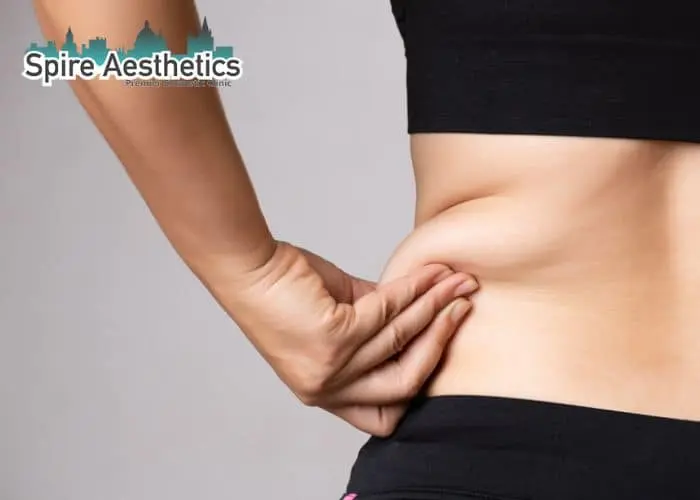 Image of woman pinching fat on their hips Thrapston. Fat Freezing treatment