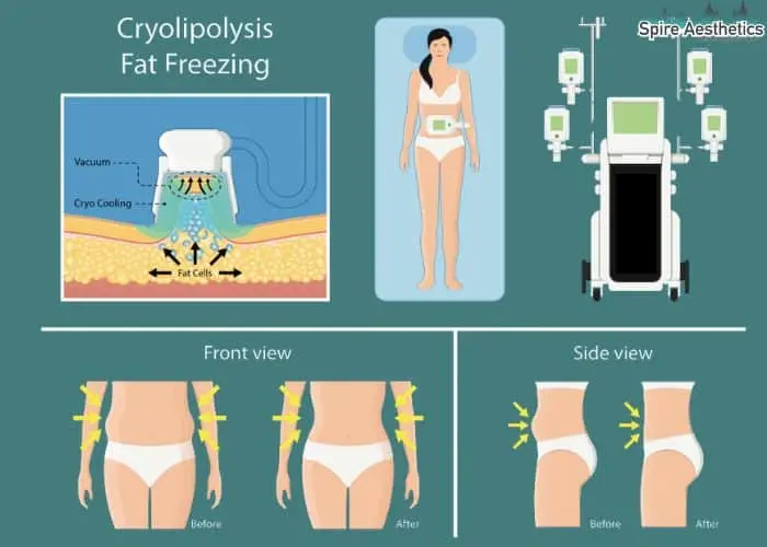 Fat freezing treatment Thrapston benefits for competitions to remove stubborn fat deposits.