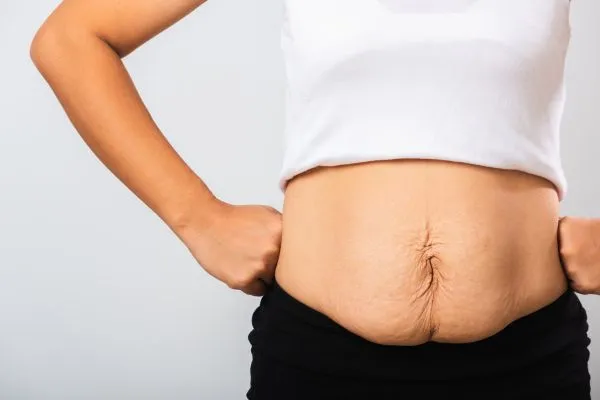Image of a woman's stomach after weight loss with sagging skin following a gastric band Thrapston