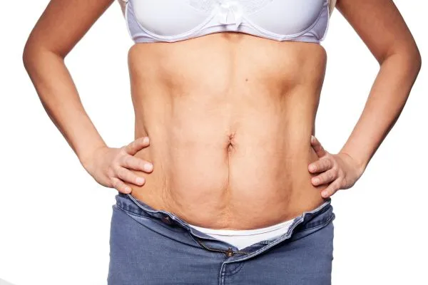 sagging skin on woman's stomach after weight loss injections Thrapston