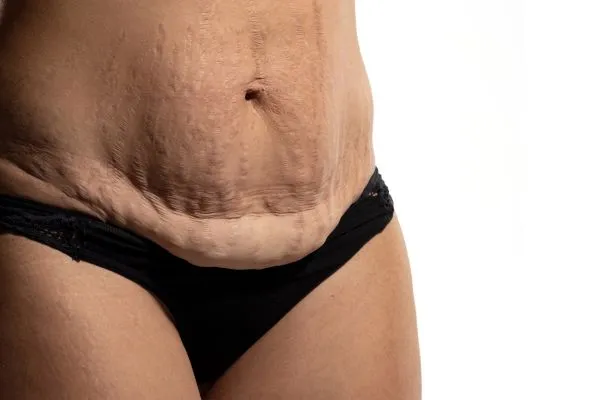Image of womans stomach after weight loss injections Thrapston showing saggy skin