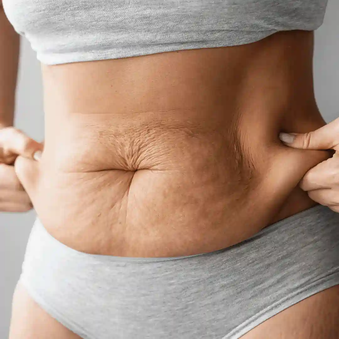 Is It Normal to Have Loose Skin After Pregnancy Thrapston?