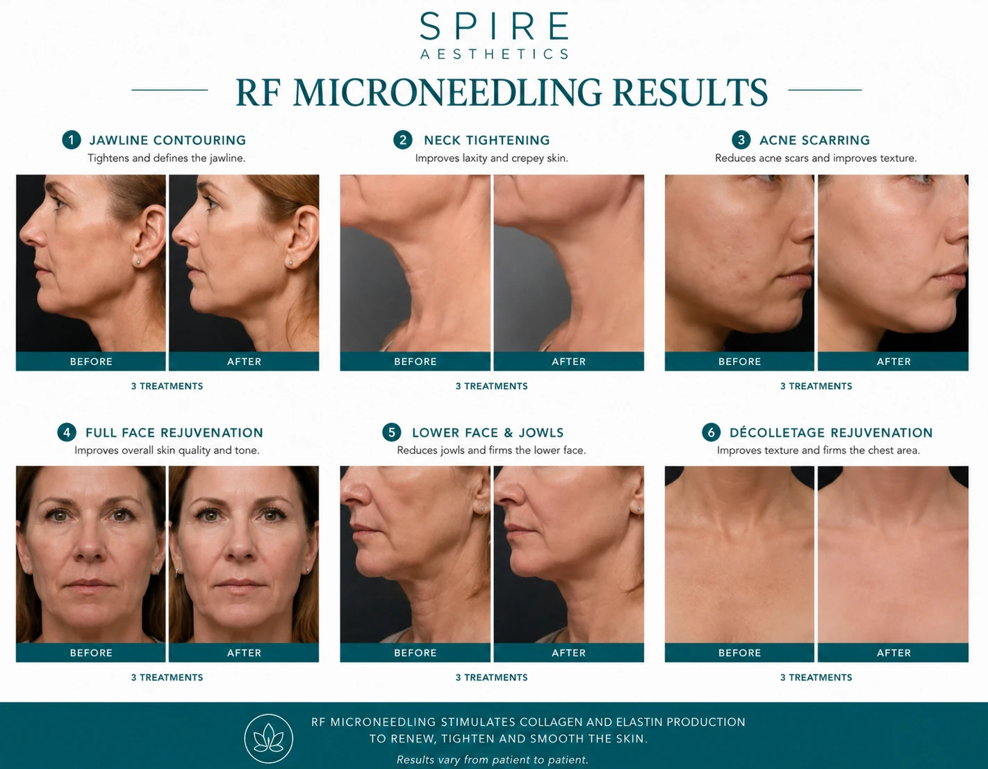 RF Microneedling Skin tightening Thrapston results