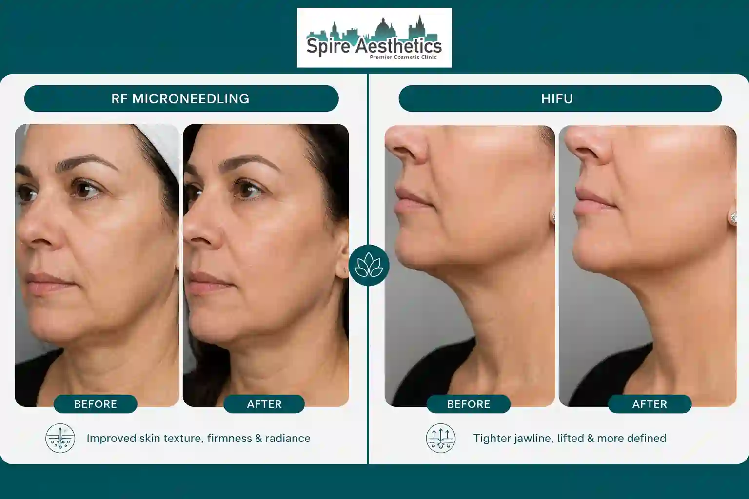 Can RF Microneedling and HIFU Be Combined Thrapston?