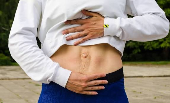 When Could Diastasis Recti Be the Missing Piece of the Puzzle Thrapston?