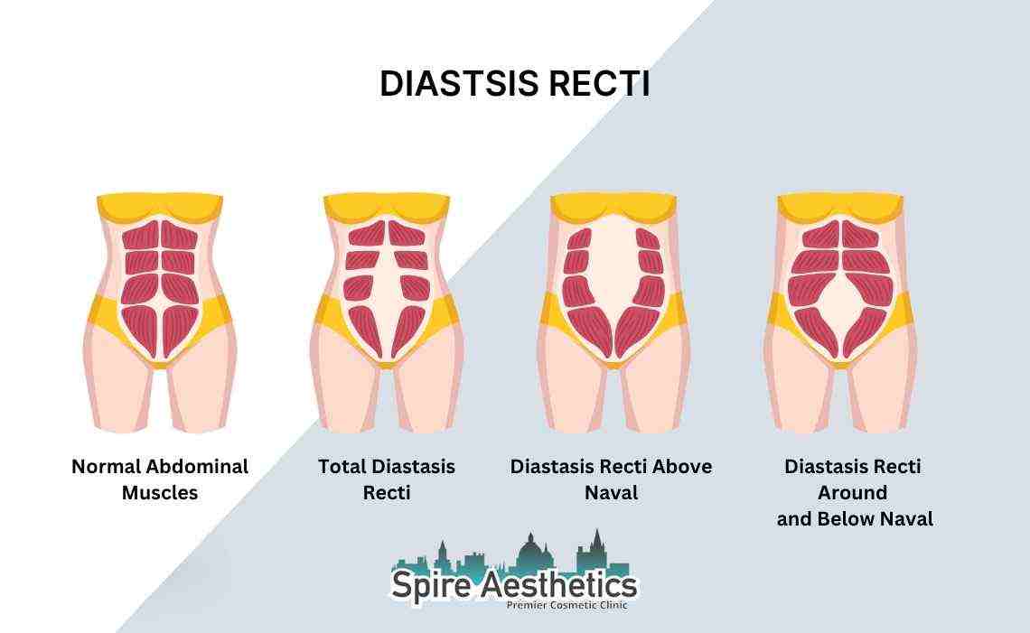Is Non-Surgical Diastasis Recti Treatment Right for You? Common Concerns Answered Thrapston